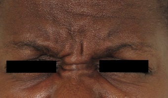 Botox