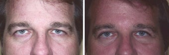 Botox Cosmetic