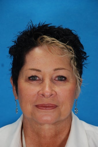 Botox and Juvederm