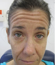 Botox