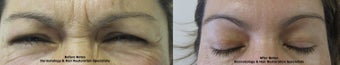 Botox
