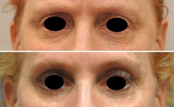 Botox around eyes