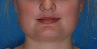 Botox for enlarged jaw muscles