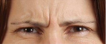 Botox
