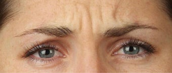 Botox