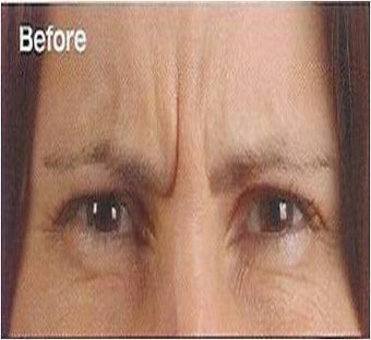 Botox