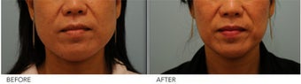 Botox Jaw (masseter) reduction