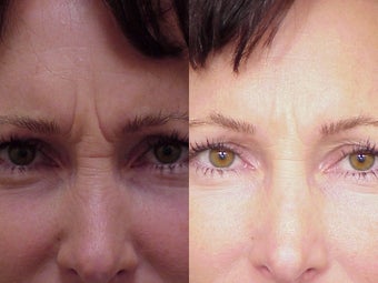 Botox