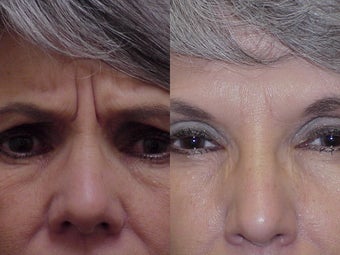 Botox