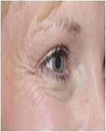 Botox