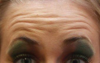 Botox