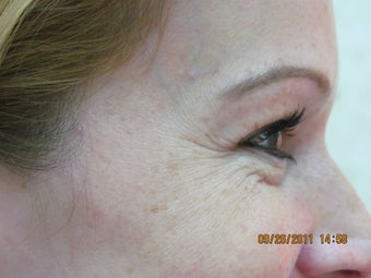 Botox for crow's feet