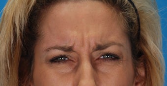 Botox