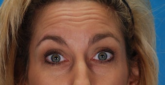 Botox