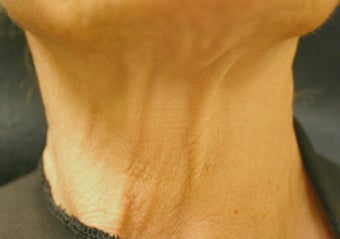 Botox 