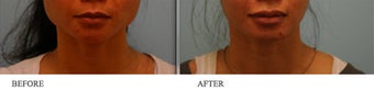 Botox Jaw (masseter) reduction