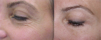 Botox 