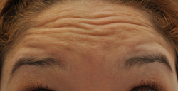 Botox to forehead and glabella
