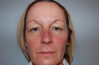 IPL Limelight Laser treatment, Pearl Laser Treatment and Botox