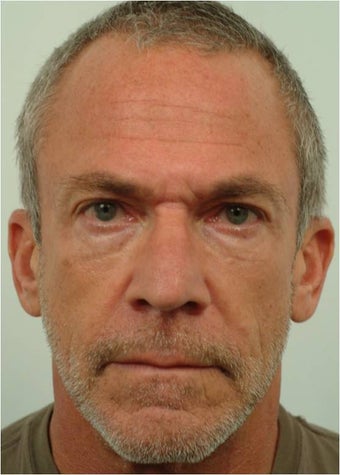 Botox between the eyebrows and across the forehead