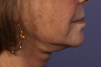 Botox to Neck (Platysmal Band Muscles)