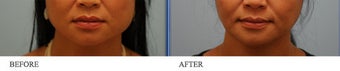 Botox Jaw Reduction