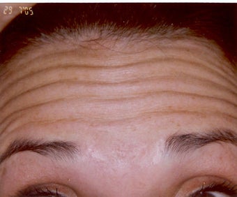 Botox