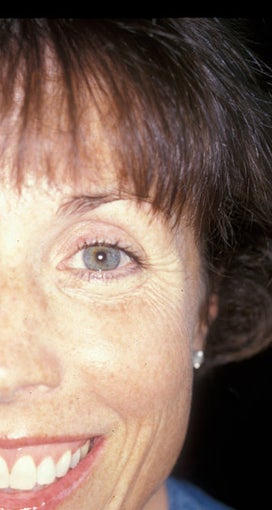 Botox