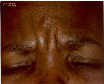 Botox