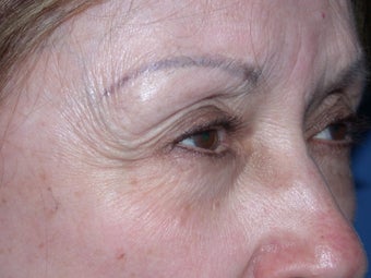 Before & After Botox Treatment