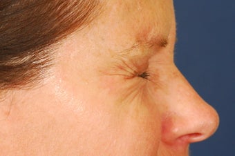 Botox Treatment of crow's feet