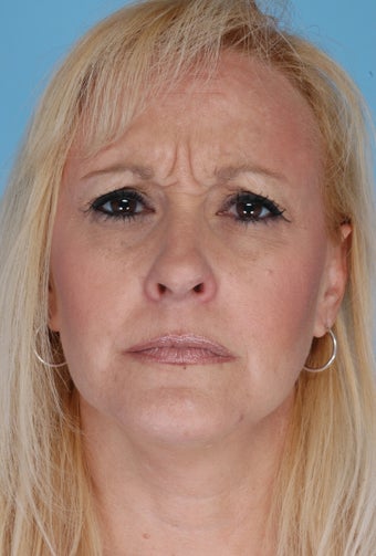 Botox