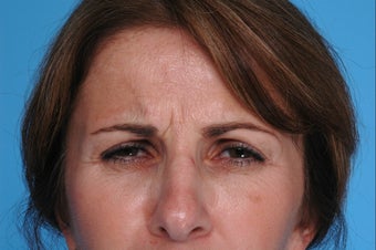 Botox