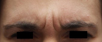 Frown Lines
