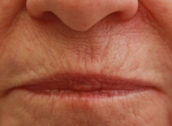 Upper Lip (whistle) lines