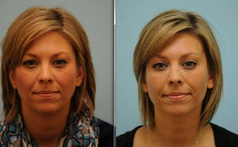 Short Term Botox