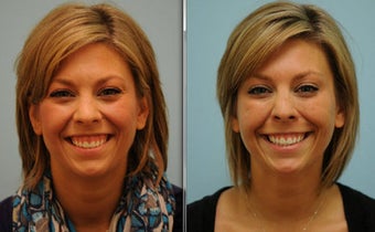 Gummy Smile Correction using Botox
