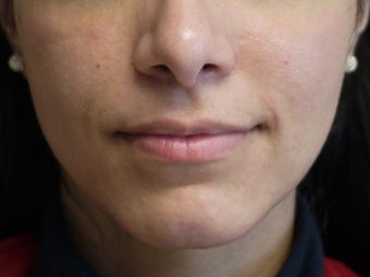 Botox Jawline Reduction