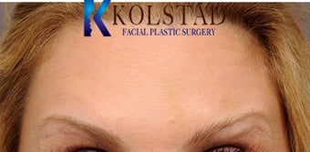 Botox