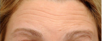 Botox