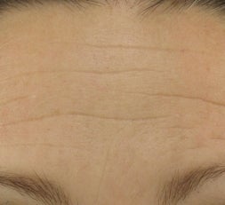 Forehead after Botox