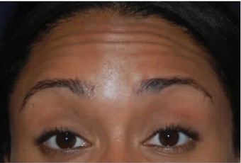 Botox to Treat Horizontal Forehead Lines