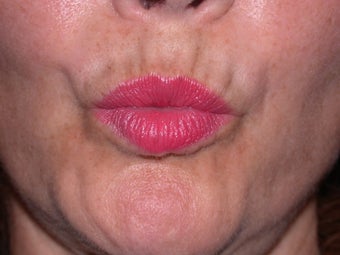 Before and After Botox to Upper Lip Lines