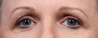 Botox and Dysport