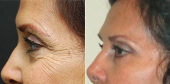 Crows Feet