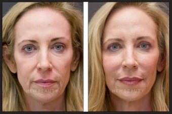 Botox & Juvederm
