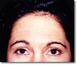 Botox
