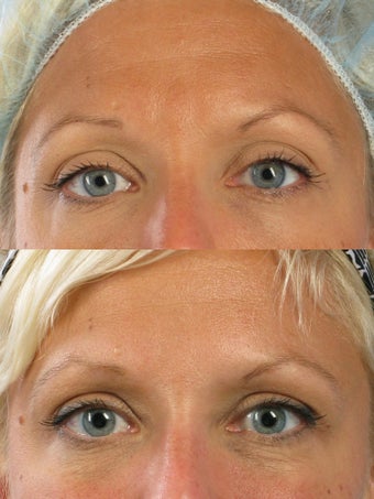 Botox for frown lines and crow's feet