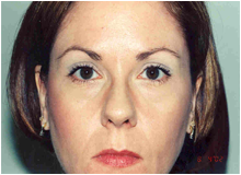 Chemical Brow Lift