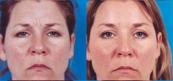Botox